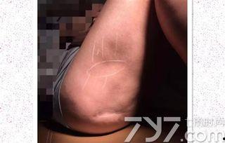 抽脂失败图片,美丽蜕变背后的风险与反思